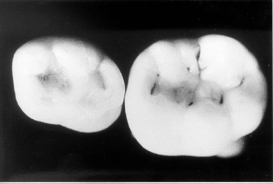 Molars-pits